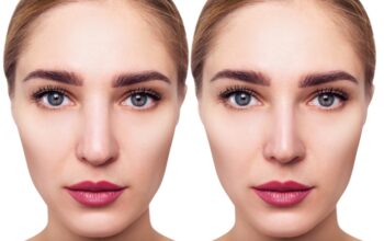 Rhinoplasty