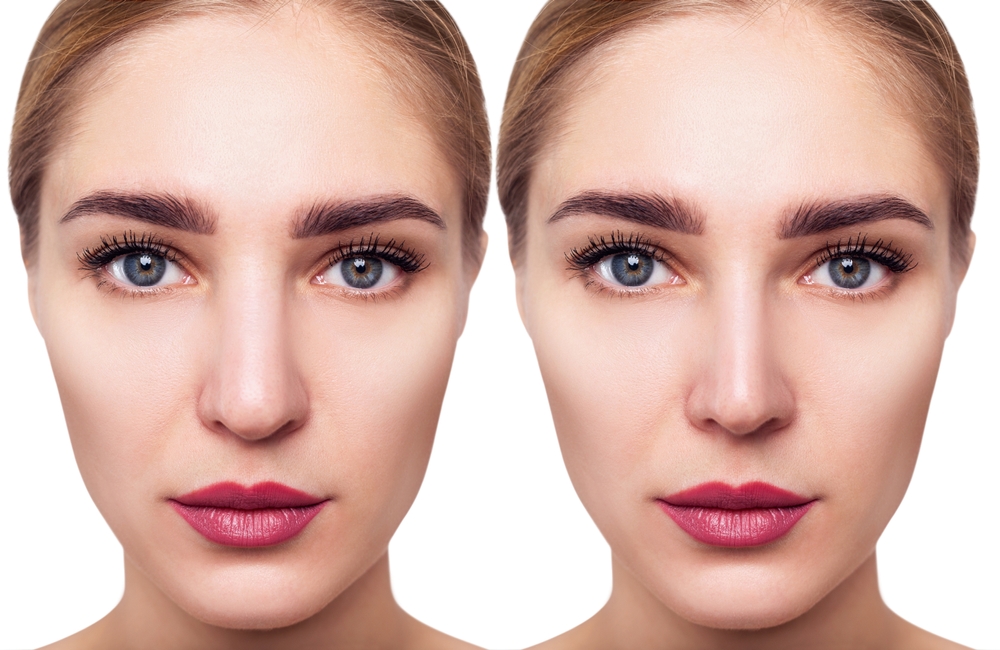 Rhinoplasty